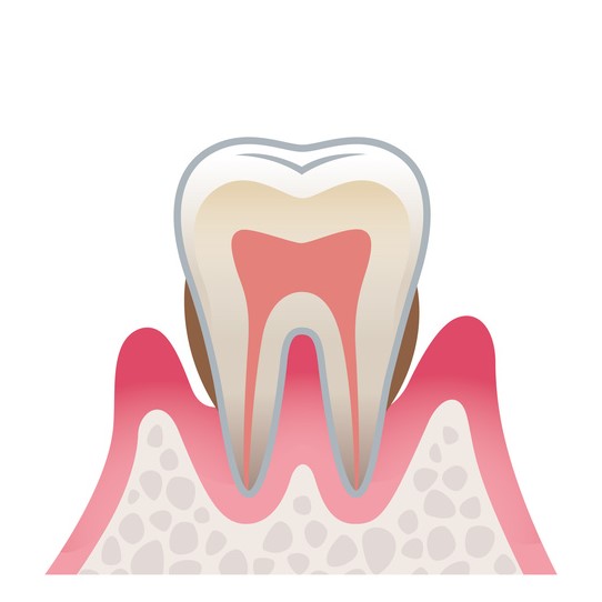 歯周炎(中程度～重度)